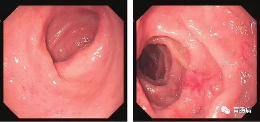 萎縮性胃炎不可怕，只要真正了解它