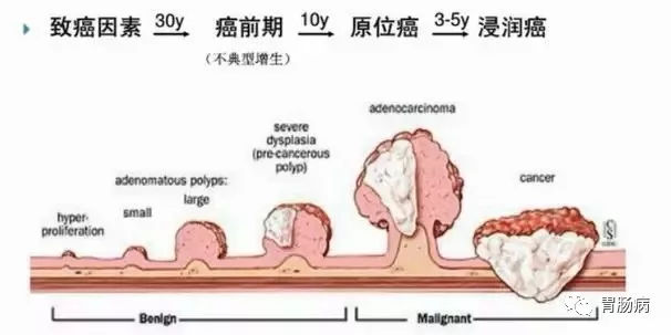 體檢查出腸息肉一定要切除！ 95%腸癌由它演變而來