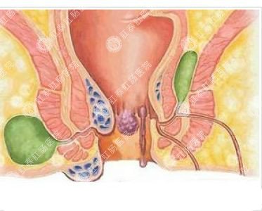 南寧哪個醫(yī)院可以做肛周膿腫？